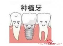 看完种植牙和镶牙的区别 还是觉得种植牙更好