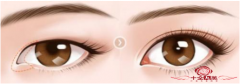 小切口重睑术做完眼睛痛多久 最为常见的整形外科手术之一