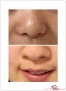 玻尿酸去除鼻唇沟有哪些特点   术后应如何护理