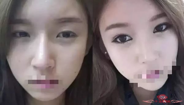 韩式三点定位双眼皮效果怎么样，有什么优势 彰显高档品质