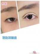 韩式五点双眼皮价格因素 为什么不同
