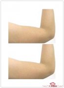 减手臂赘肉最有效的运动法