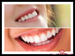 药物漂洗法和光敏贴面可以美白牙齿吗
