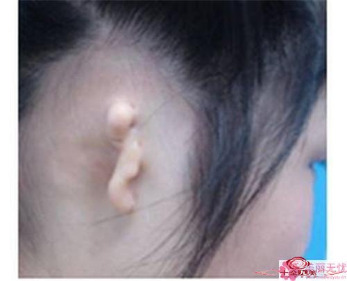 耳轮缺损修复的手术方法及并发症