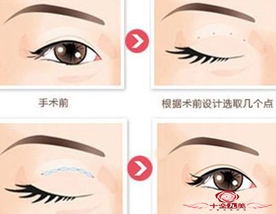 做假体鼻整形费用是多少